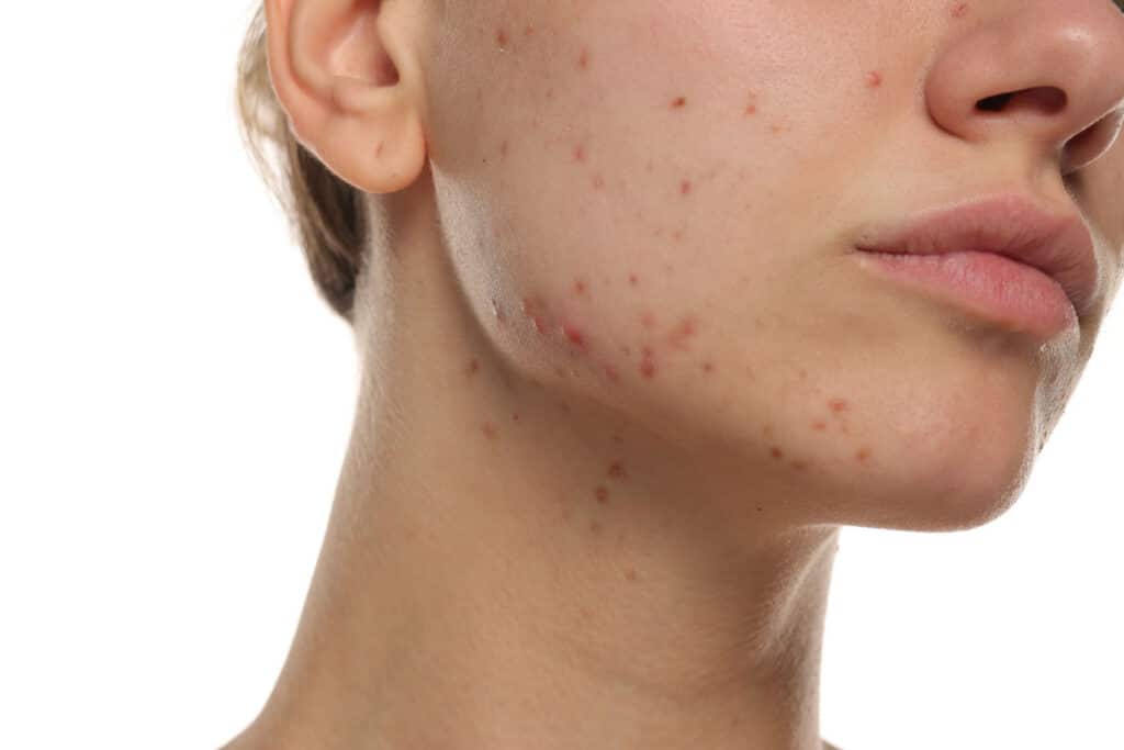 microneedling and rf treatments for acne scars san diego aesthetics and medspa
